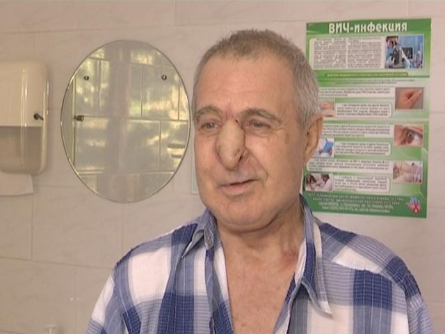На Кубани врачи восстановили нос пациенту из тканей его организма