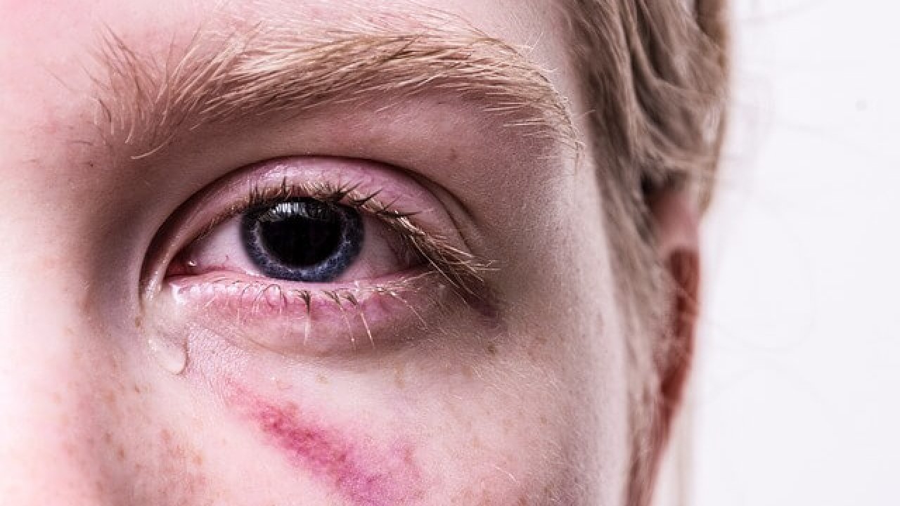 Как убрать синяк под глазом — советы как лечить синяк под глазом