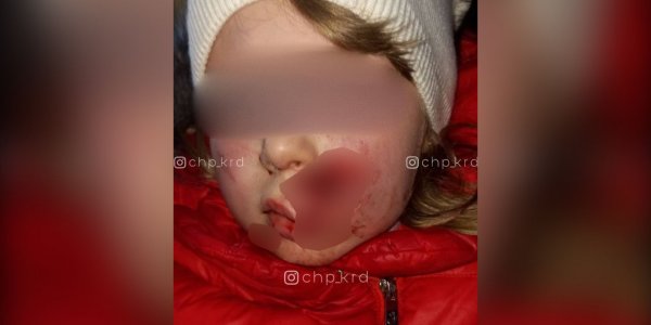 В Краснодаре собака разорвала лицо 7-летней девочке