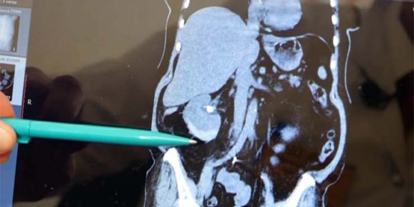 В Армавире врачи удалили из почки пациентки камень со спичечный коробок, сохранив орган