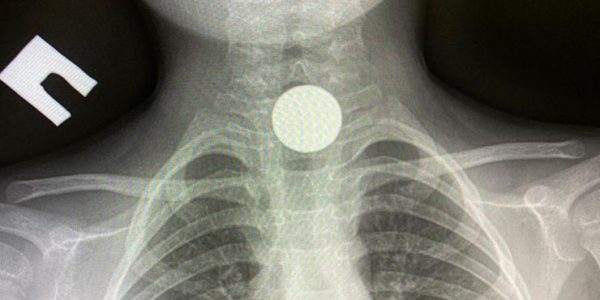 В Краснодарском крае врачи достали монету из пищевода 4-летнего ребенка