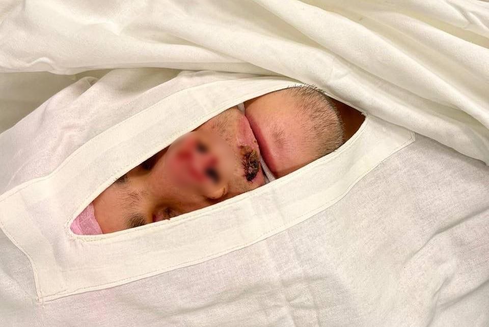 Краснодарские врачи восстановили парню откушенный в драке нос