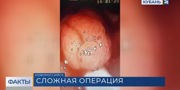 Врачи городской больницы Новороссийска провели сложнейшую операцию на кишечнике