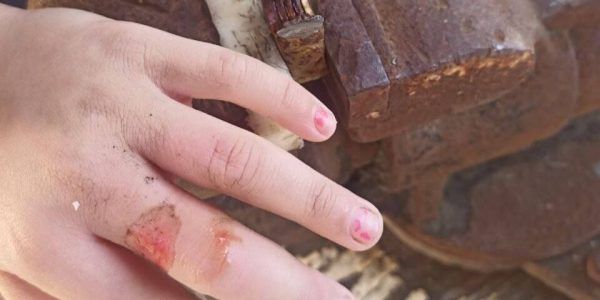 В Новороссийске спасатели больше двух часов бормашиной спиливали гайку с пальца 5-летней девочки