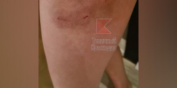 В департаменте образования Краснодара прокомментировали нападение собаки на школьницу во дворе лицея