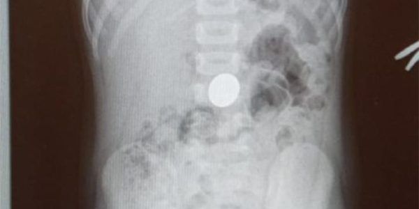 В Туапсе врачи извлекли пятирублевую монету из желудка четырехлетнего ребенка