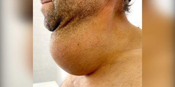 Росла два года: мужчину с огромной опухолью на шее прооперировали в Краснодаре