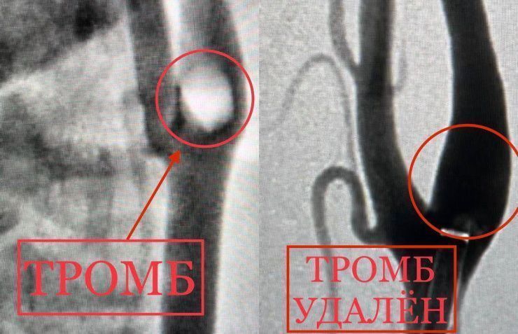 Новороссийские хирурги спасли пациентку с крупным тромбом в сонной артерии