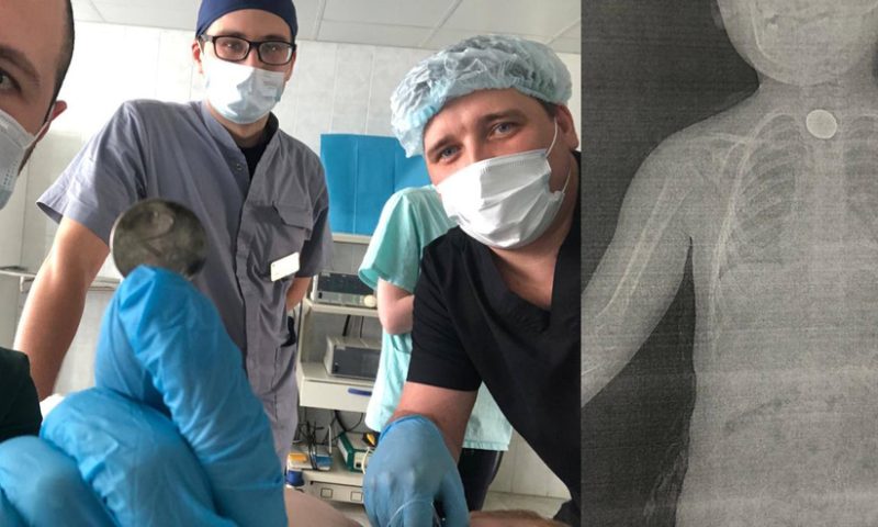 В Новороссийске хирурги достали из пищевода 3-летнего мальчика двухрублевую монету