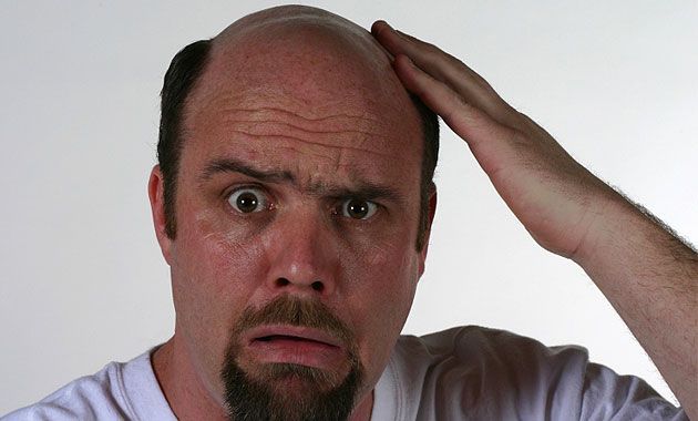Как не облысеть раньше времени: проблема выпадения волос у мужчин