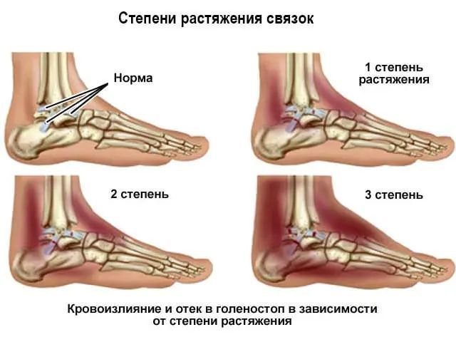 Разрыв связок коленного сустава - симптомы и лечение - travmasport