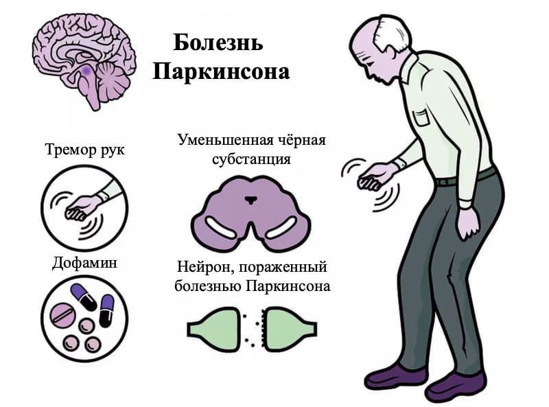 Доктор Мясников назвал 10 признаков болезни Паркинсона - 10 апреля, 2023  Статьи «Кубань 24»