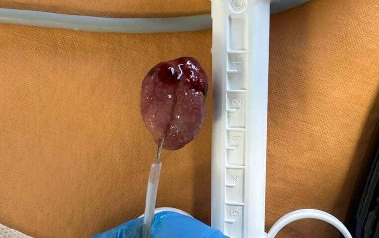 Крупную кровоточащую опухоль удалили из кишечника 7-летнего ребенка хирурги Новороссийска