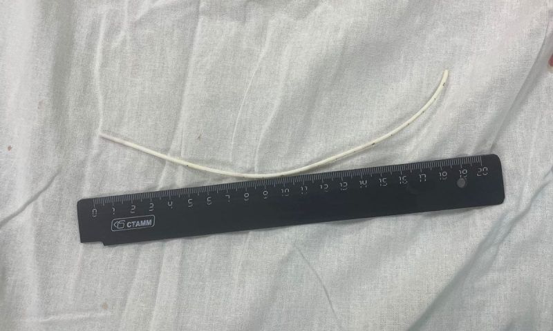 В Новороссийске хирурги вытащили из сердца женщины 20-сантиметровый катетер