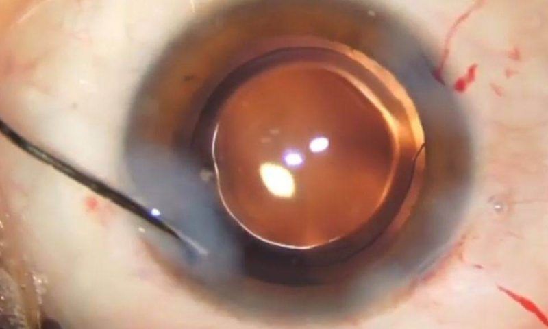 В Новороссийске хирурги вернули зрение 93-летней женщине с последней стадией катаракты