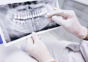 В Госдуме предложили включить протезирование зубов для пожилых россиян в ОМС