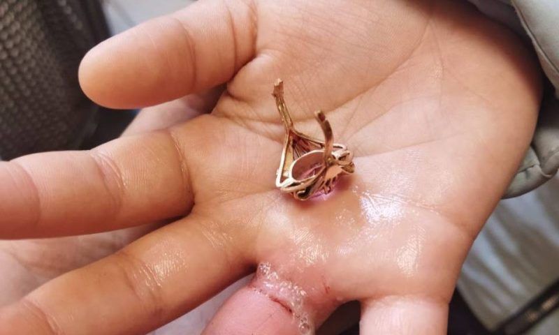 В Новороссийске спасатели помогли девочке снять кольцо с отекшего пальца