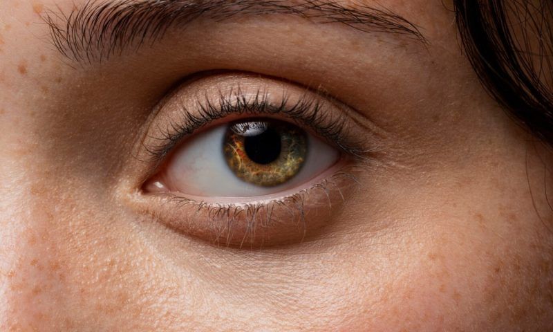 Пингвекула глаза – симптомы, причины, диагностика и лечение в «СМ-Клиника»