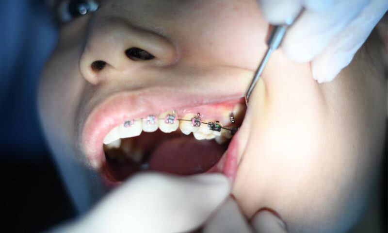 Стоматолог Антипенко назвал противопоказания для установки брекетов