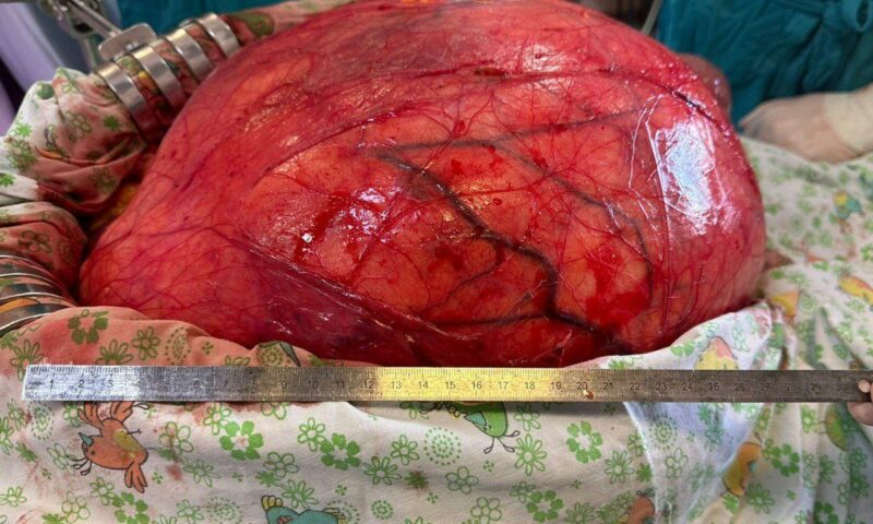 Гигантскую опухоль весом 17 кг удалили из живота мужчины в Краснодаре