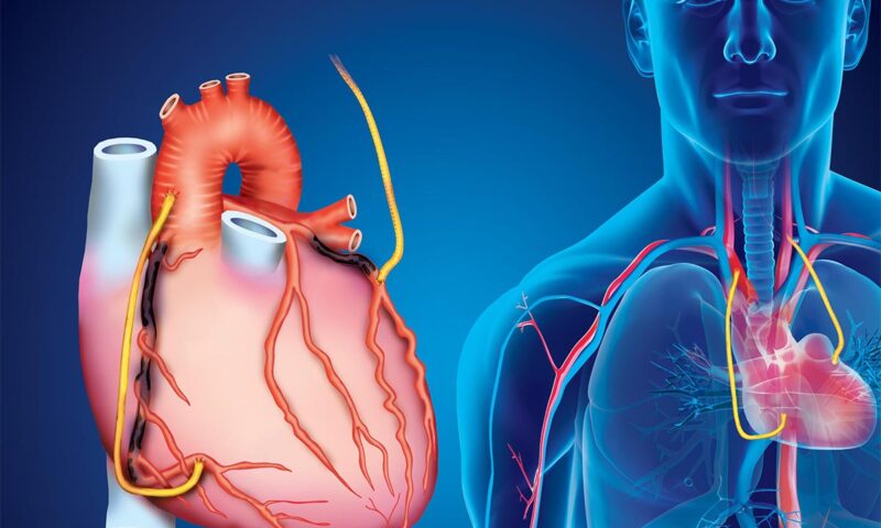 Аортокоронарное шунтирование: как проводят операцию, риски и показания