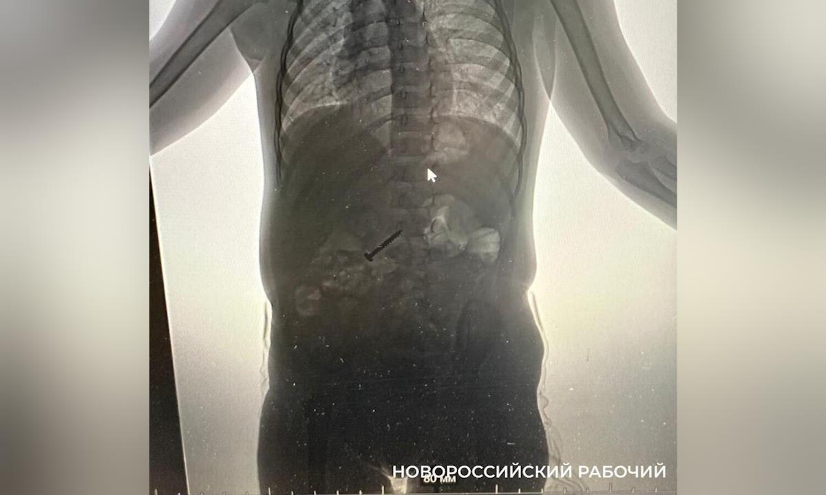 В Новороссийске врачи достали саморез из желудка 2-летней девочки