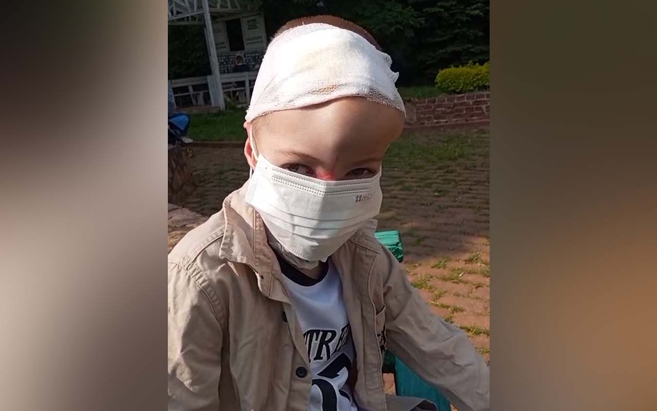 Отец искусанного хаски мальчика из Сочи показал лицо сына после пластики