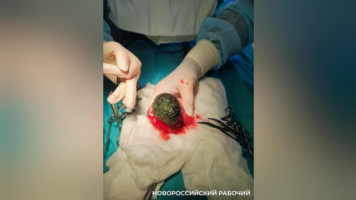 Огромный комок волос удалили врачи из желудка 4-летней девочки в Новороссийске