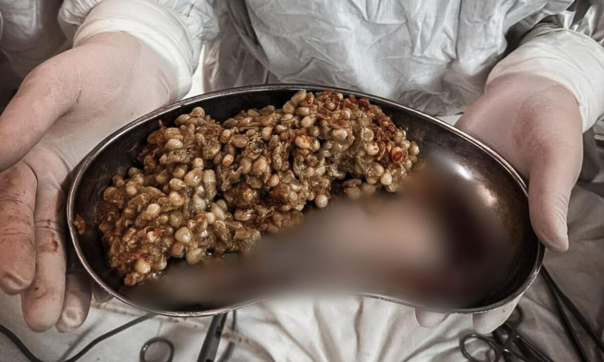 На Кубани хирурги спасли женщину с комком непереваренной кукурузы в кишечнике